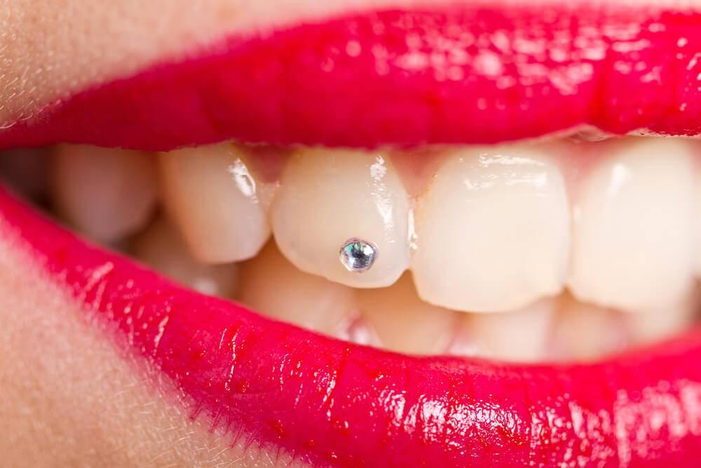 Piercing no dente: entenda os prós e contras desse estilo