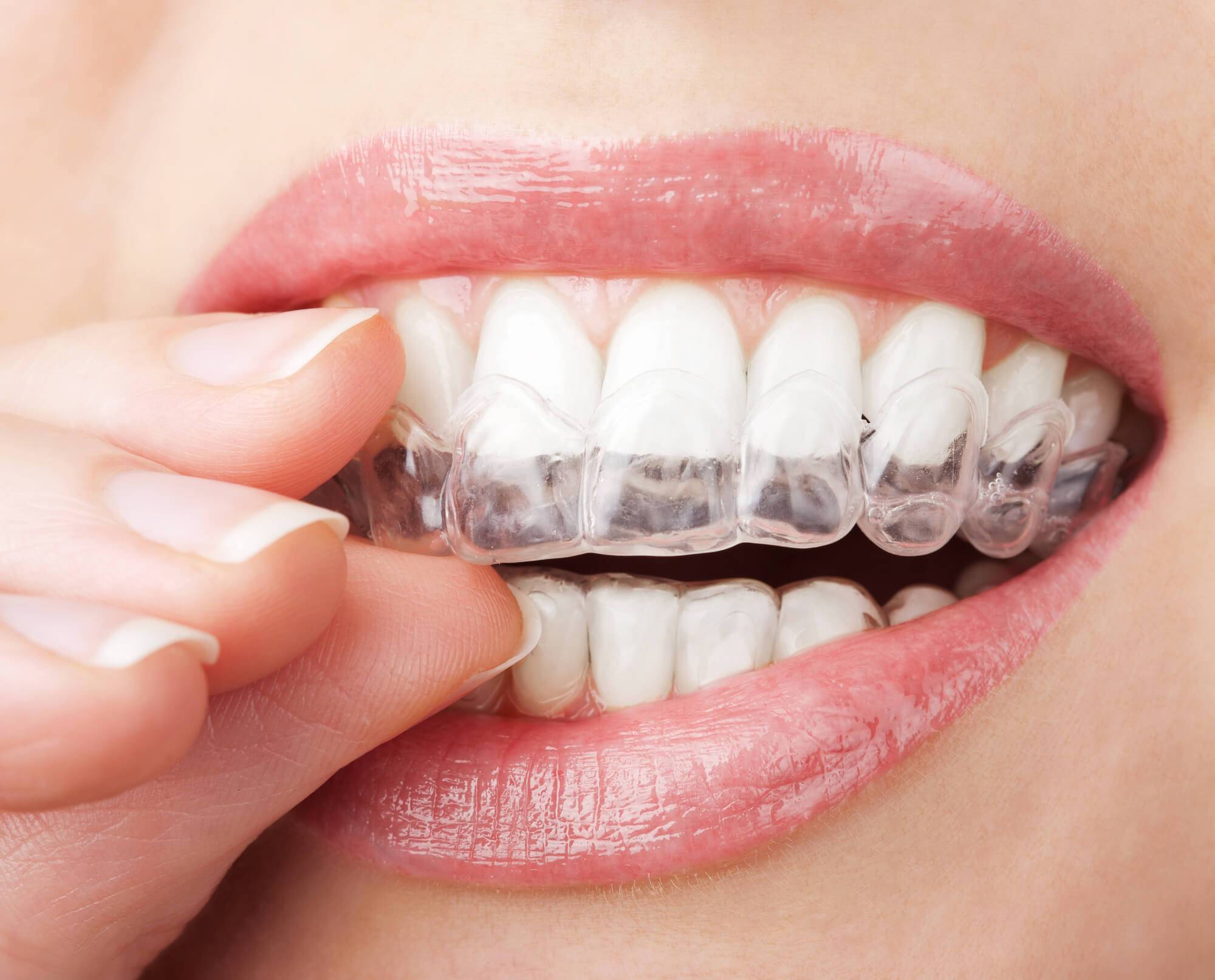 5 motivos para optar pelo aparelho dentário transparente